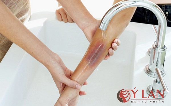 Cách phòng tránh khi bị bỏng